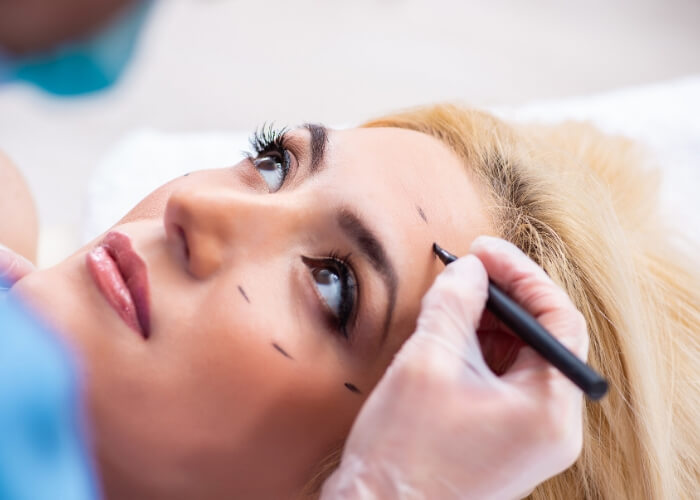 Young woman laying on an exam table while a doctor marks the area for her ocuplastic surgery